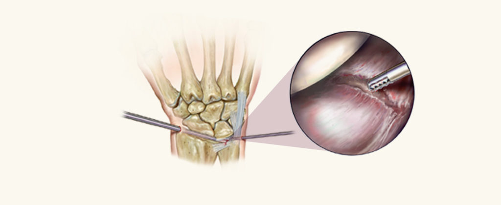 Arthroscopic Surgery Diagram