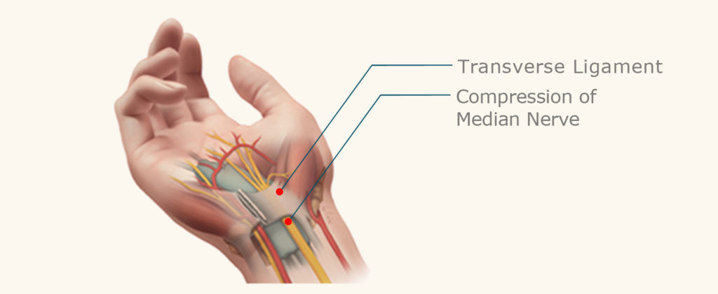 Carpal Tunnel Diagram