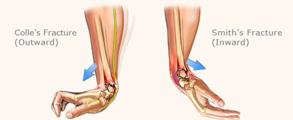 Colle's and Smith's Fracture Diagram