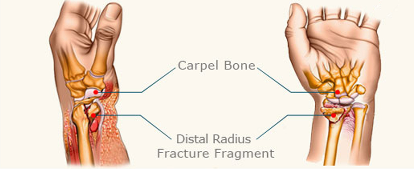 Distal radial fractures diagram 1