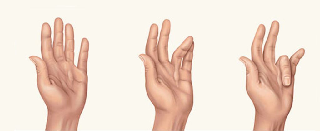 dupuytren-contracture