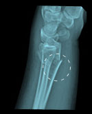 extra-articular-fracture