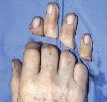 Successful replantation of all four fingers