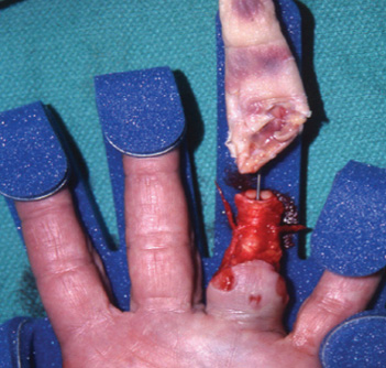 Ring Avulsion