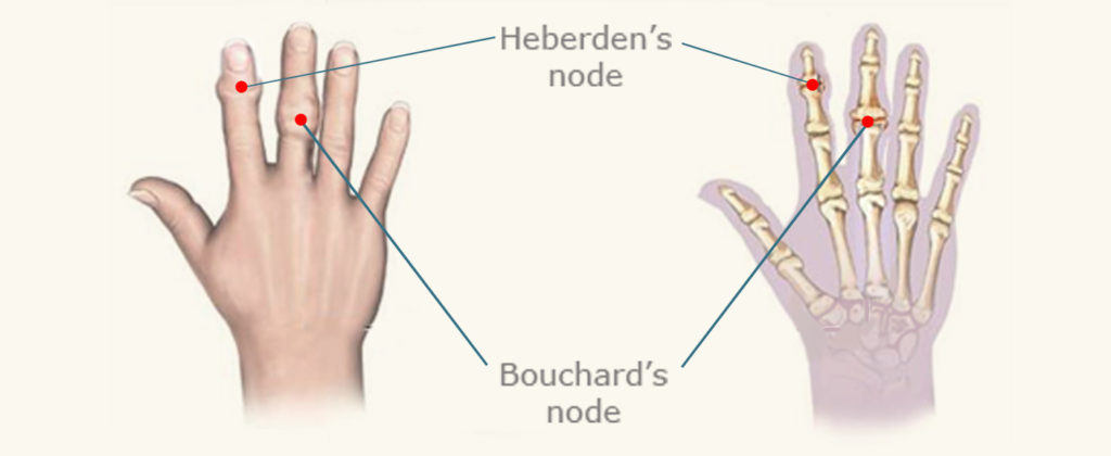 heberden's nodes hand diagram