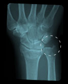 Intra-Articular Fracture