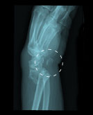 open fracture x-ray