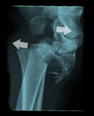 shear-fracture
