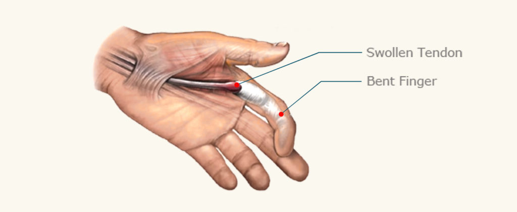 Trigger Finger Diagram