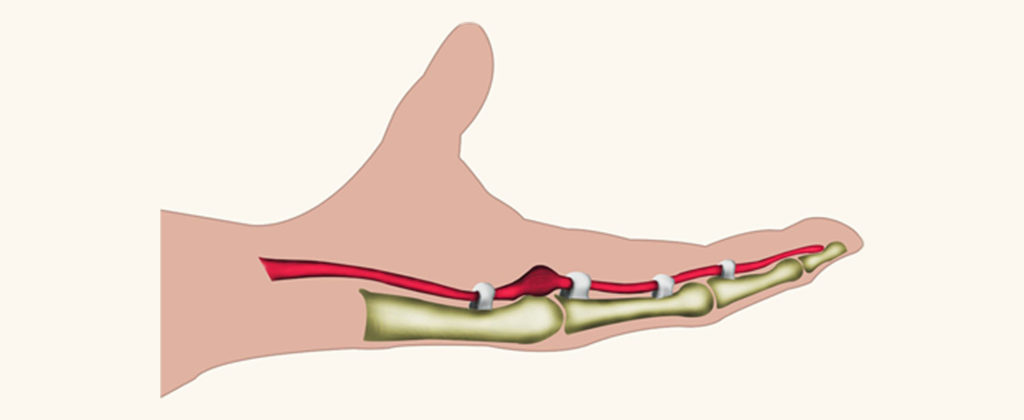 Trigger Finger diagram