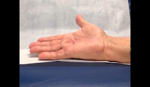 Hand post severe Dupuytern's Contracture treatment.