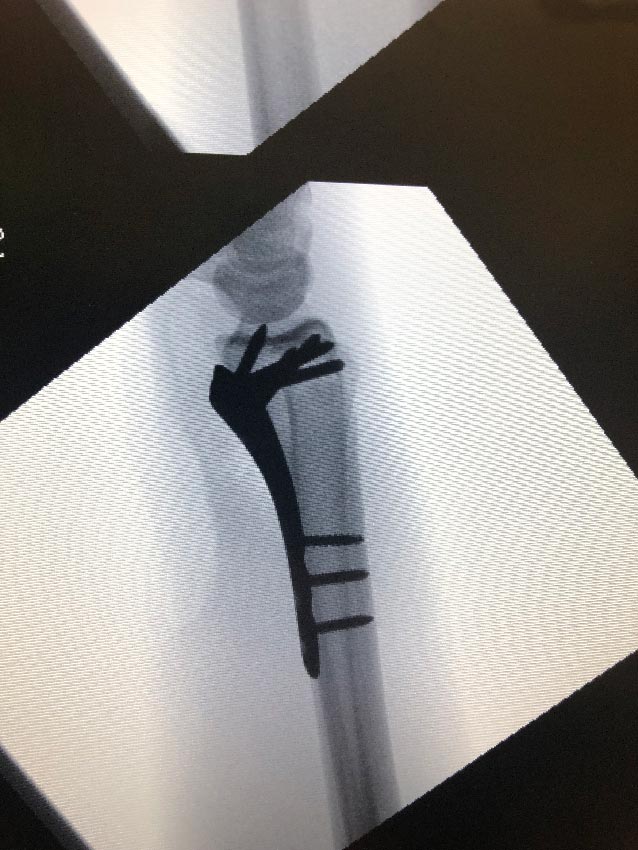 Pin placement in x-ray of arm