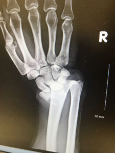 Distal Fracture X-Ray 1