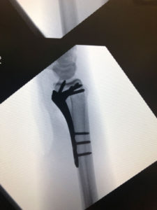 Distal Fracture X-Ray 2
