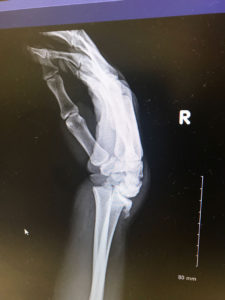 Distal Fracture X-Ray 3