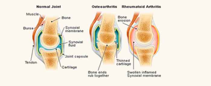 Illustration contrasting a normal joint with osteoarthritis and rheumatoid arthritis.