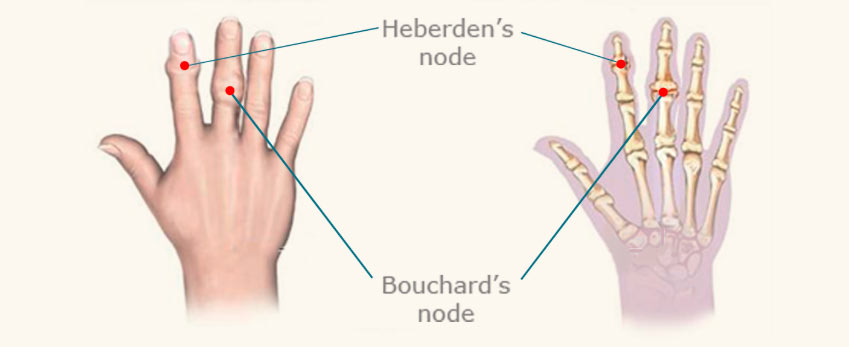Illustration of a hand with Heberden's node and Bouchard's node.